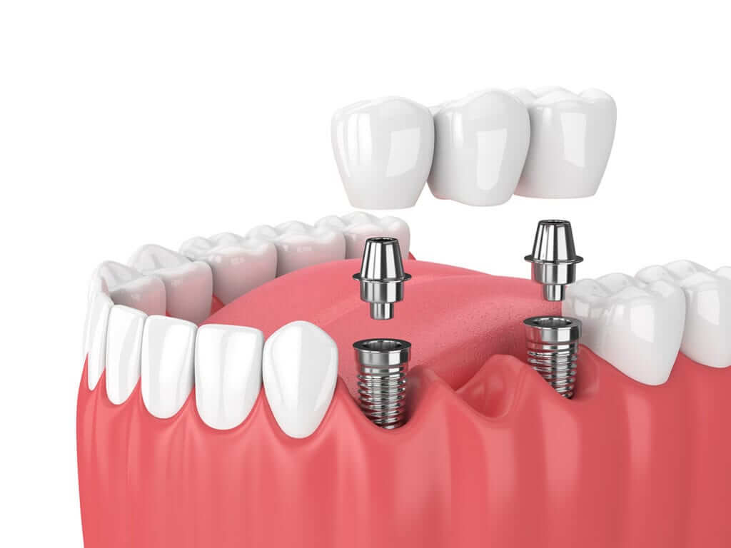 Dental Implants vs. Dentures and Bridges