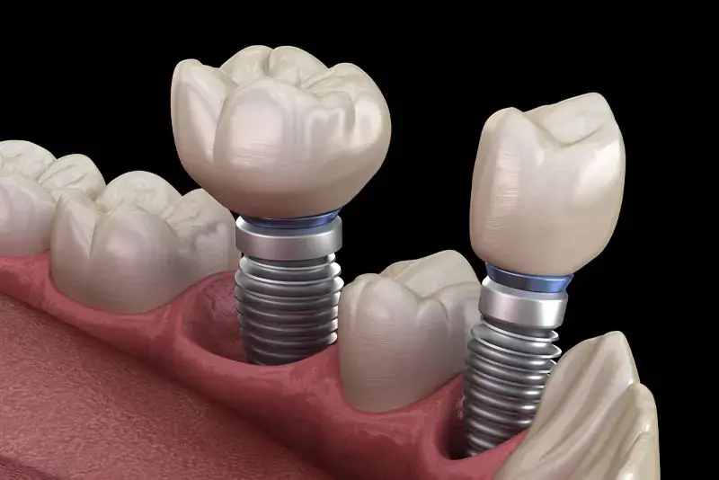 dental-implantmulti