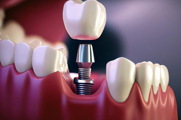 dentalimplantsinmgle
